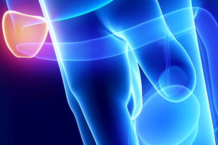 prostate-cancer prostate-cancer