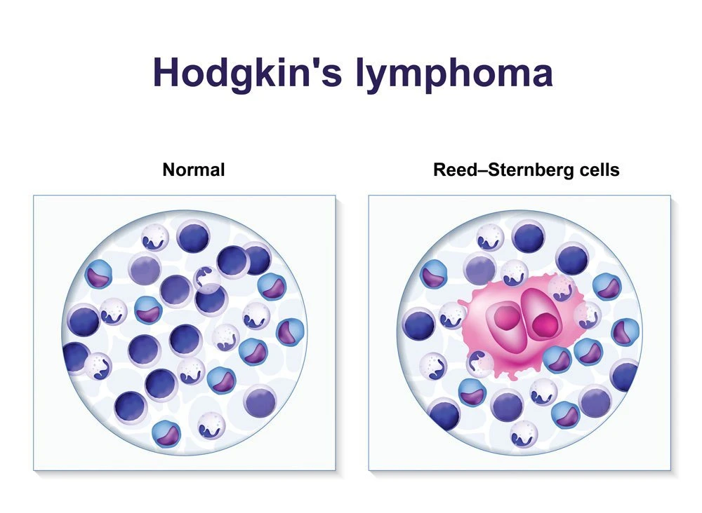 a hodgkin lymphoma diagram comparing normal cells with reed sternberg cells