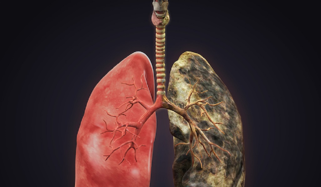 İleri Akciğer Kanserinin Belirtileri ve Yan Etkileriyle Başa Çıkmak