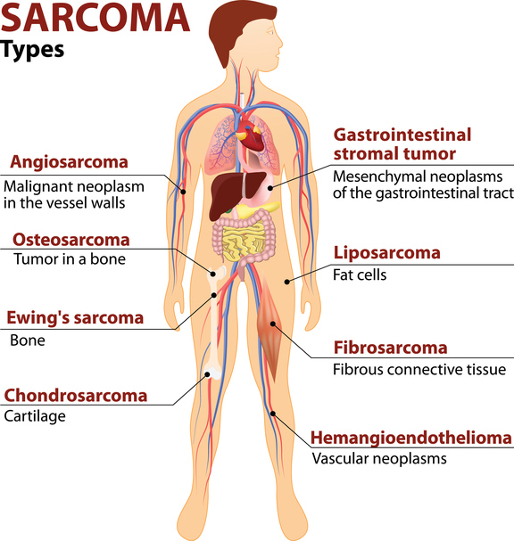 Sarcoma cancer from radiation, REVIEW-URI - Sarcoma cancer from radiation