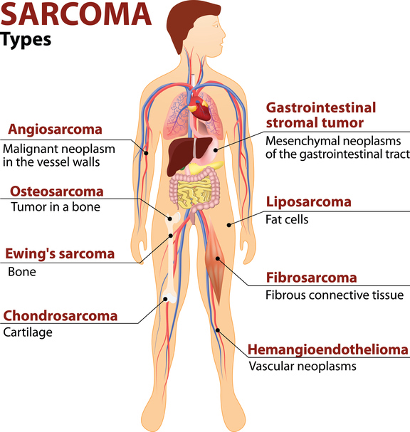 sarcoma cancer definition