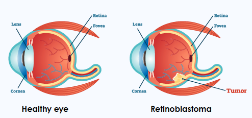 Jenis retinoblastoma